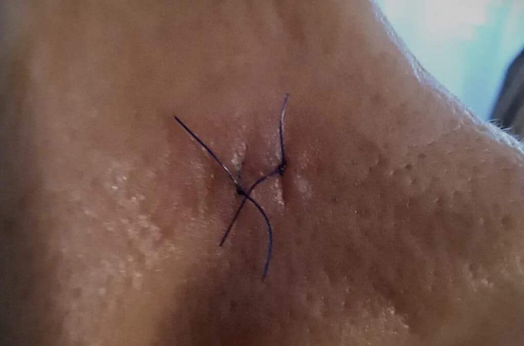 Kto zdejmuje izolacje? Kluczowe informacje o usuwaniu szwów po operacji